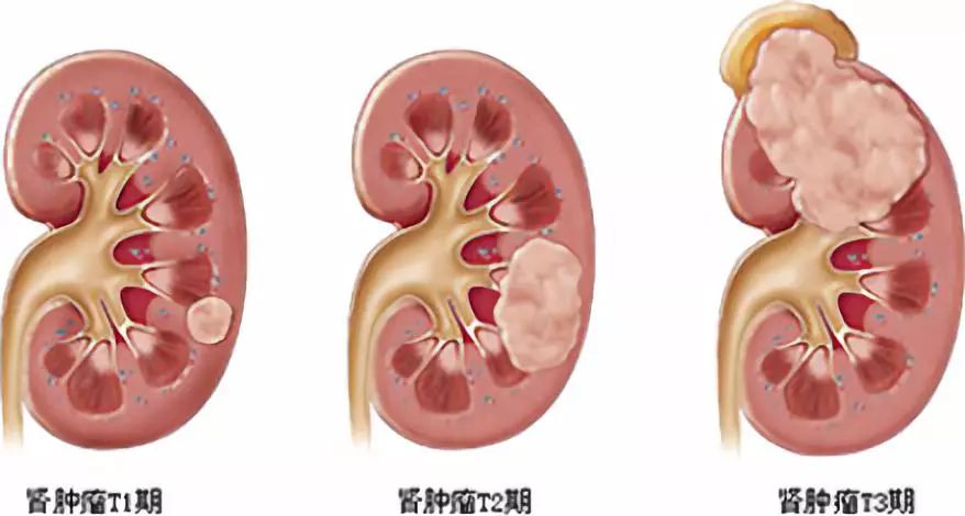 女性咽喉癌的早期癥狀圖片