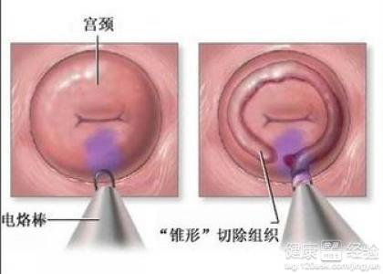 宮頸肥大需要治療嗎專家講解