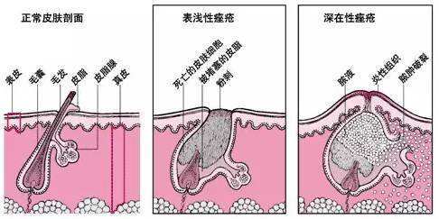 治療痤瘡的最好醫(yī)院,治療痤瘡的最好醫(yī)院，系統(tǒng)化分析與說(shuō)明,科學(xué)解答解釋定義_進(jìn)階版18.44.30