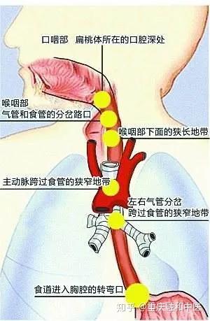 女子吃火鍋被魚刺卡喉致食管破裂,女子吃火鍋遭遇魚刺卡喉致食管破裂的狀況分析解析說明,全面數(shù)據(jù)執(zhí)行方案_Executive99.31.41